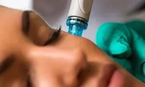 Microneedling sessions